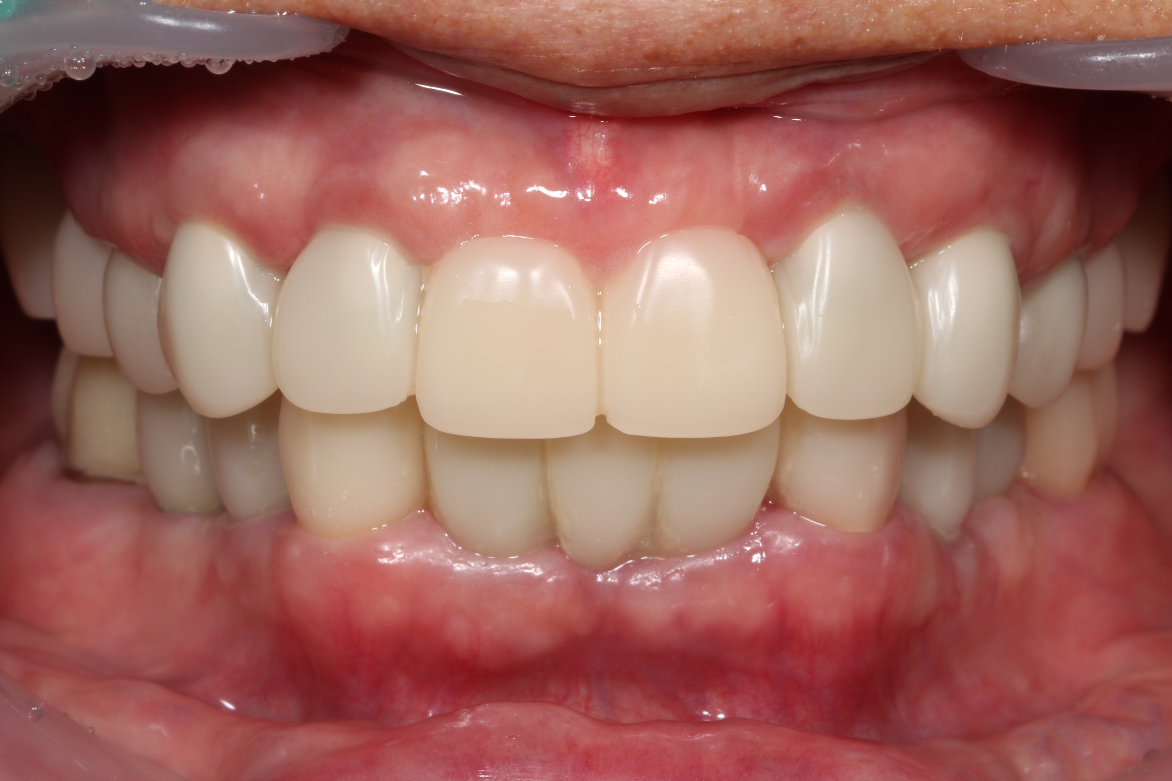 치료 후 임상사진