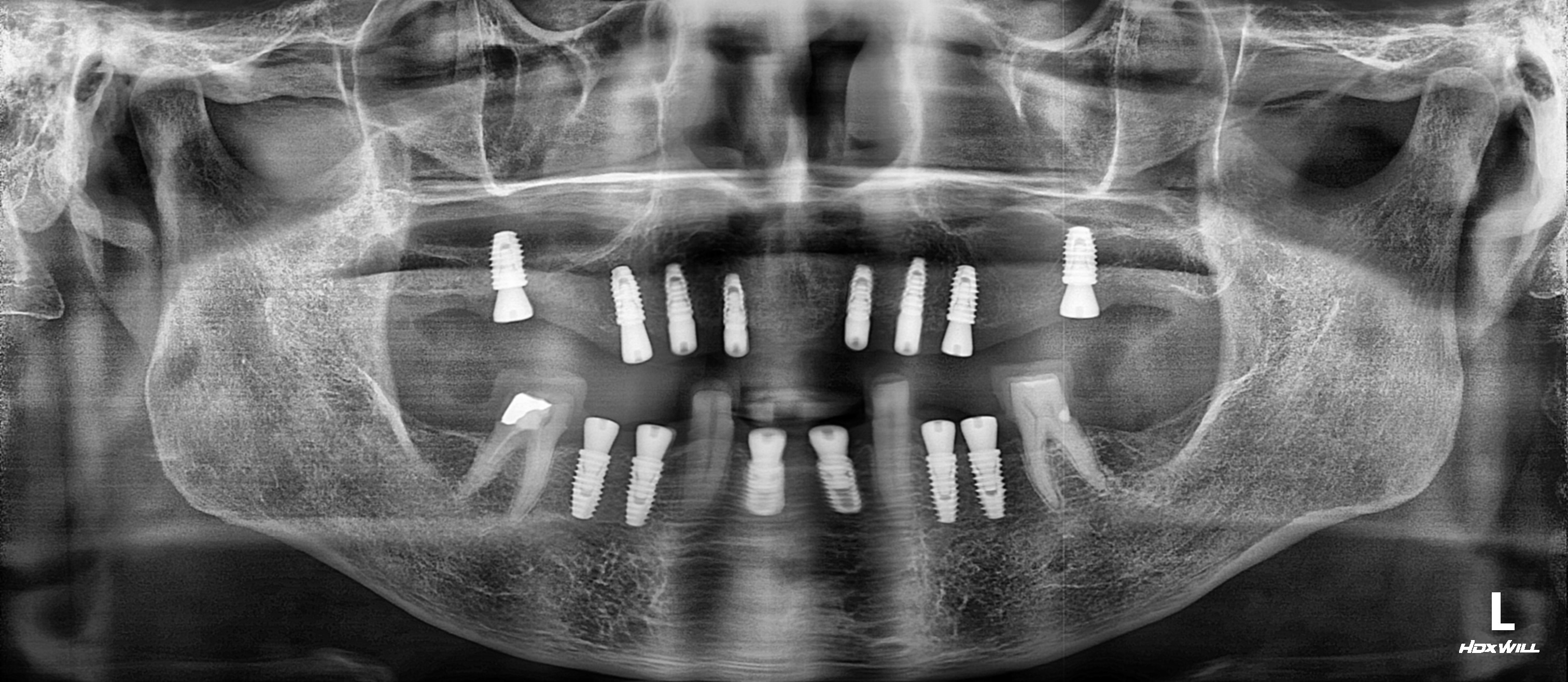 임플란트 엑스레이
