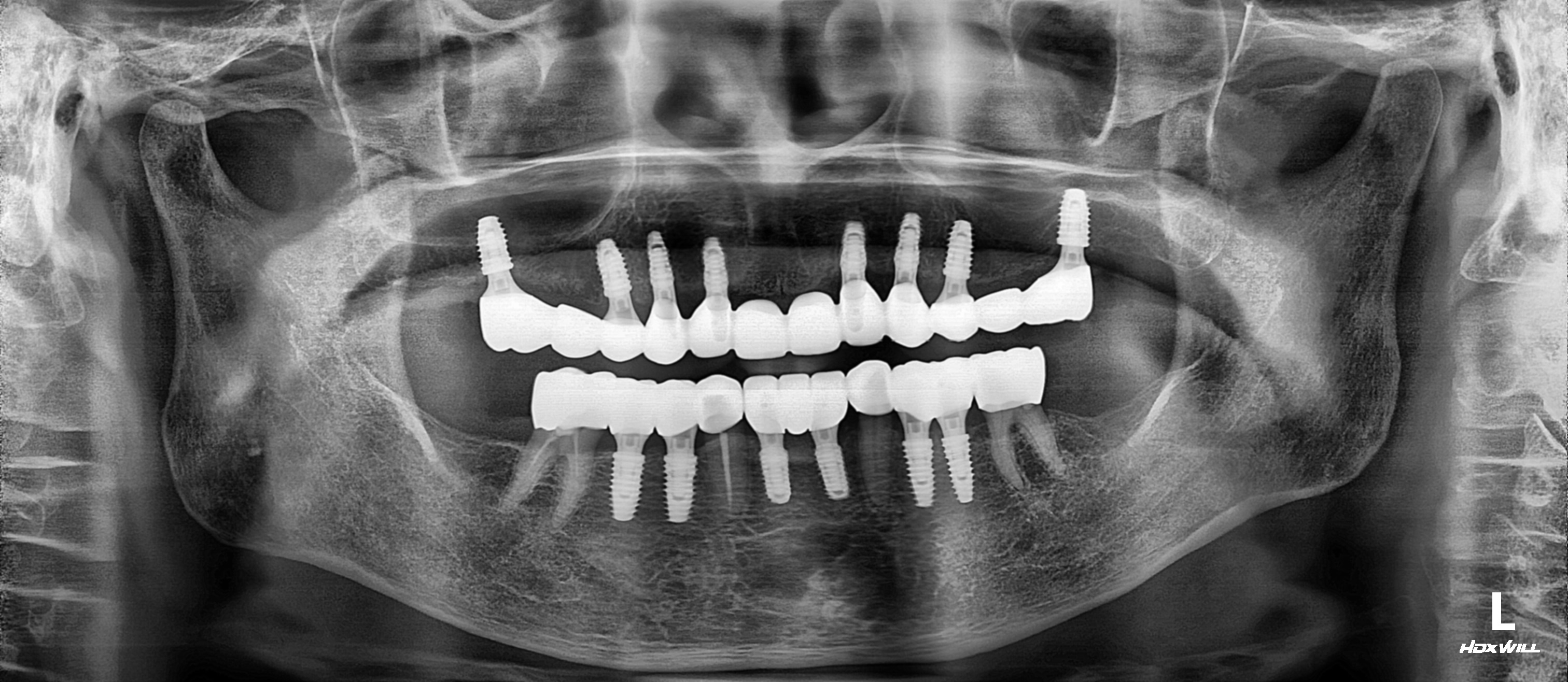 치료 후 파노라마