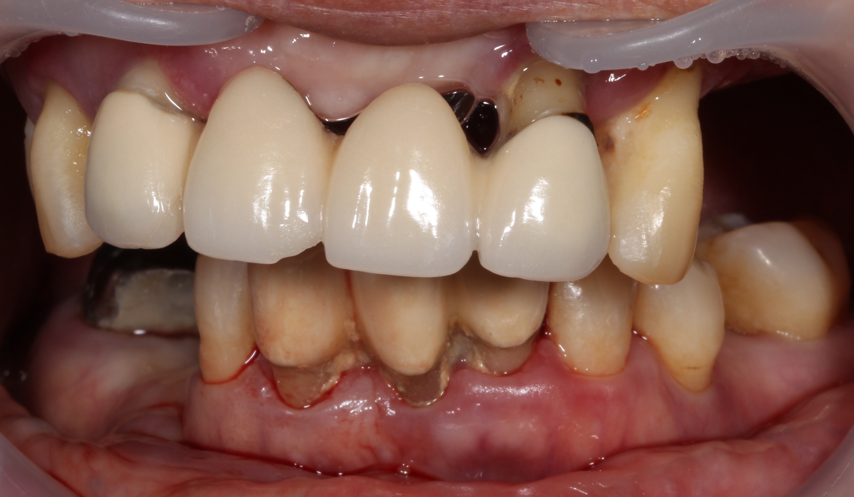 치료 전 임상사진