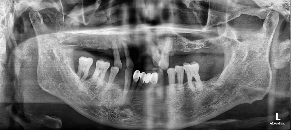 치료 전 임상사진 / X-ray