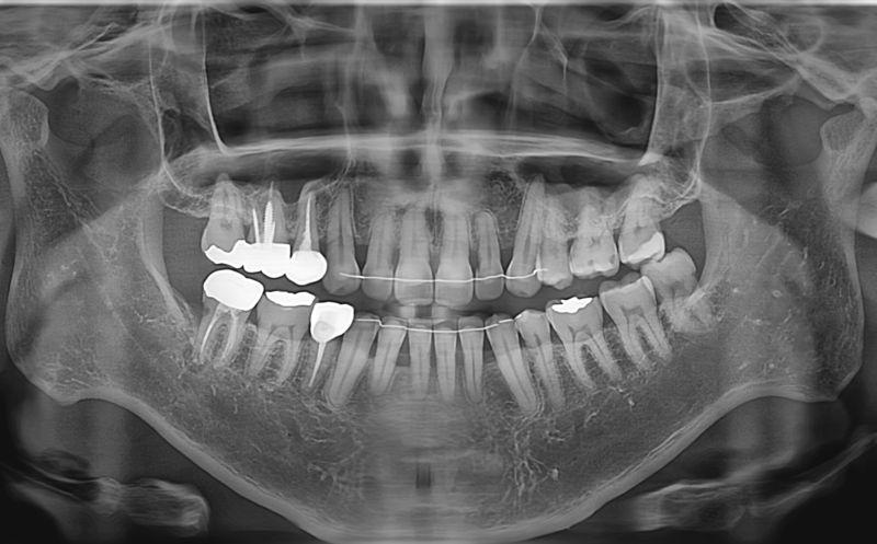 치료 전 임상사진 / X-ray