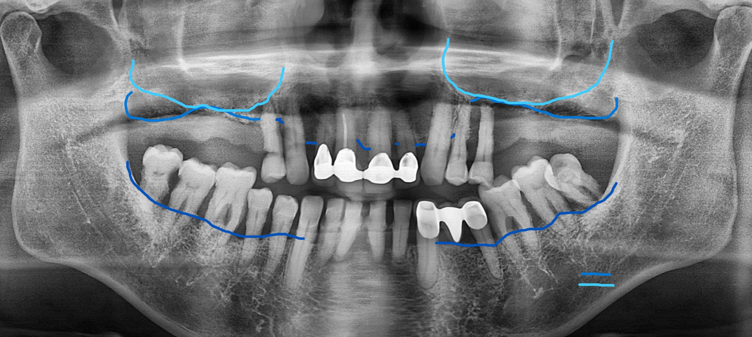 치료전 CBCT 사진