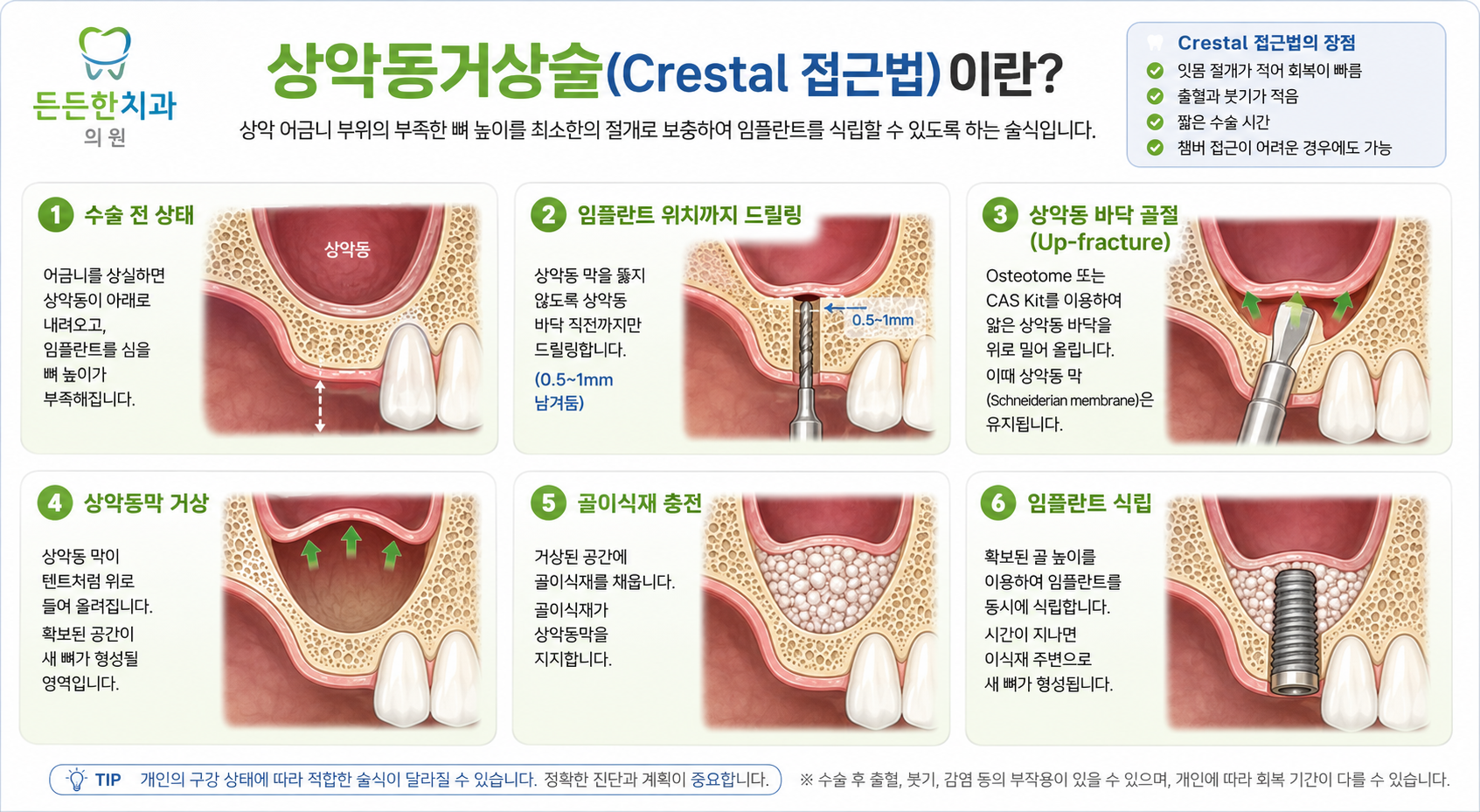 상악동 거상술 모식도